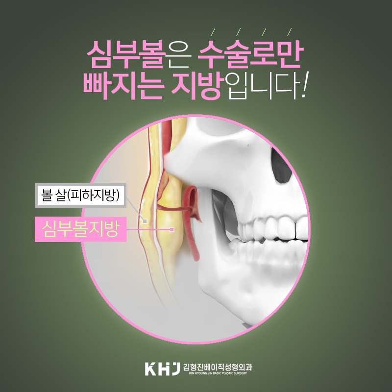 얼굴지방흡입으로 매끈하게 다듬고 싶다면 관련 이미지 3