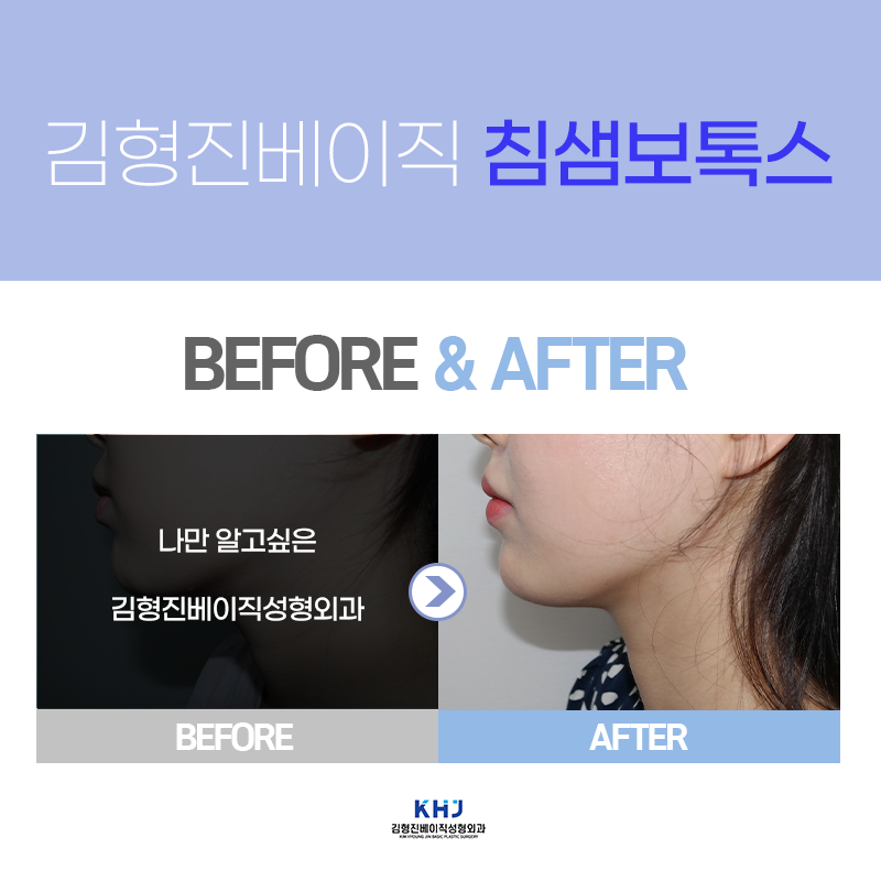 침샘보톡스전후 궁금하시다구요? 관련 이미지 4