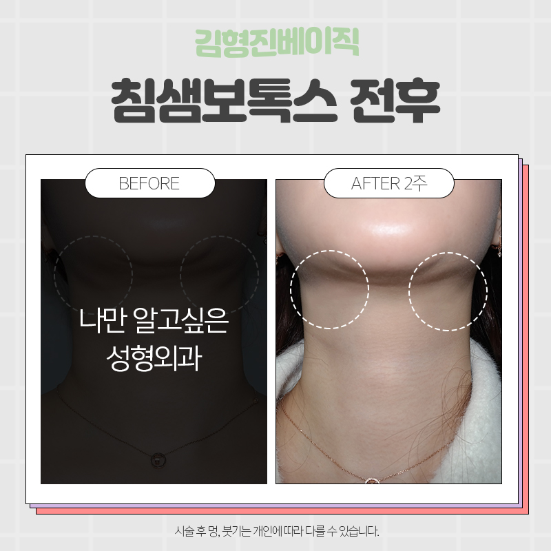 침샘보톡스효과 아직 모르시는분? 관련 이미지 4
