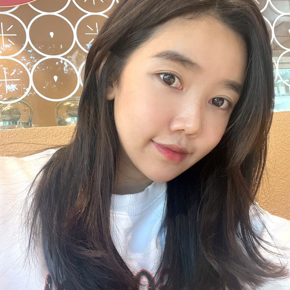 울룩불룩한 눈 밑, 눈밑지방재배치수술로 해결했어요 관련 이미지 1