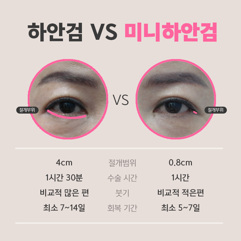 아직도 미니하안검효과 어떤지 모르세요? 관련 이미지 4