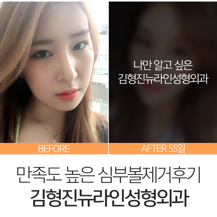 심부볼제거후기 내 맘에 아주 쏙 들어 관련 이미지 3