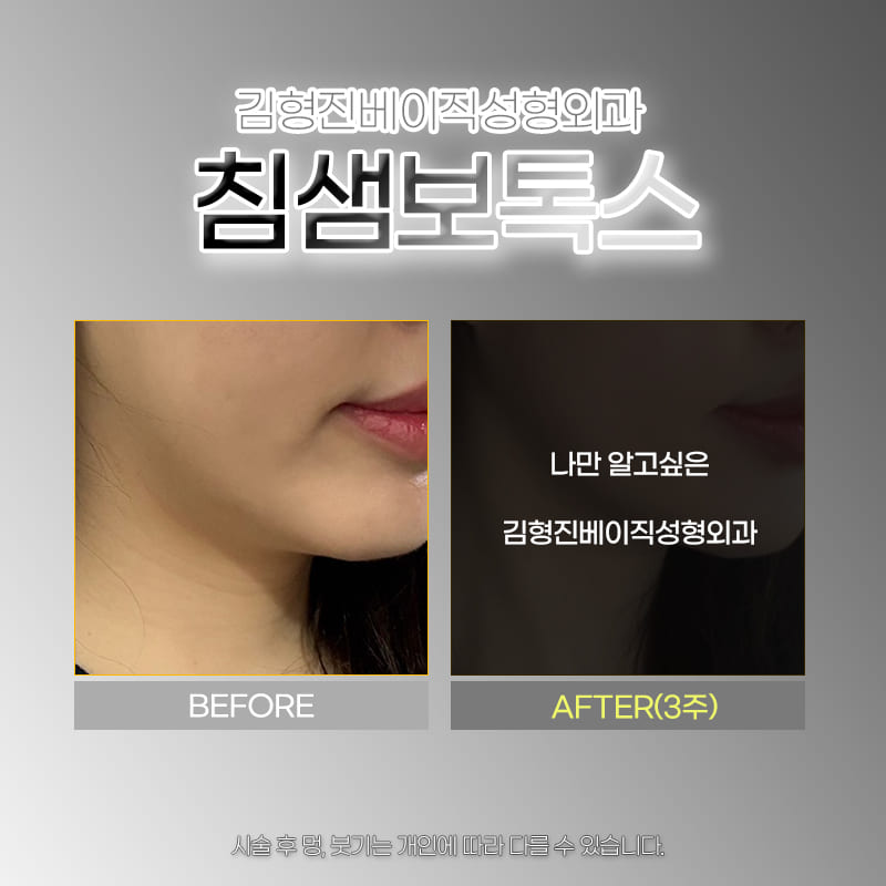 Salivary Gland Botox Review: Creating a Smooth Jawline image 5