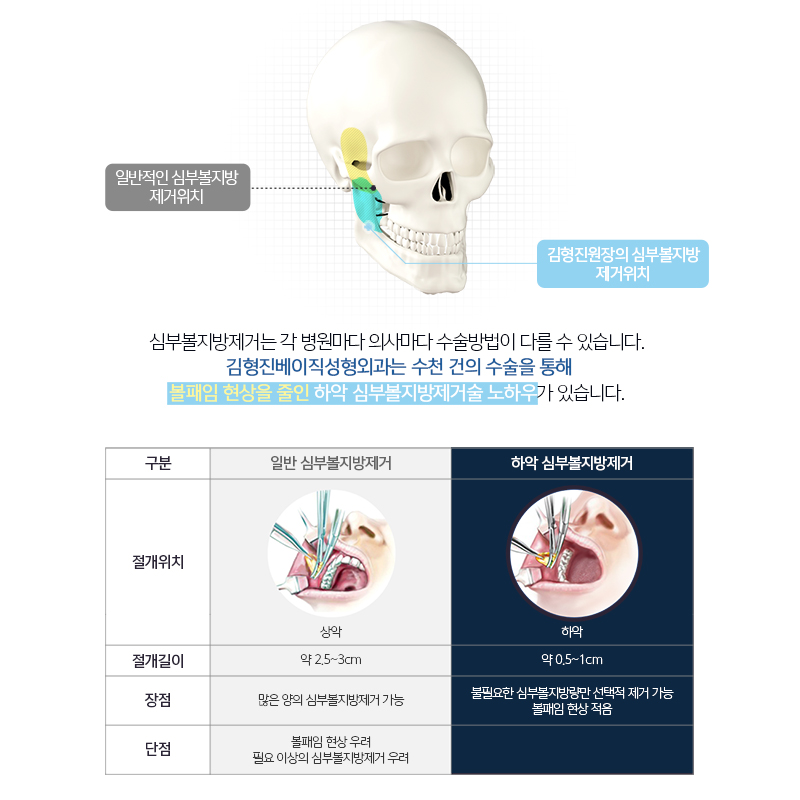 하악심부볼제거로 갸름한 얼굴라인을! 관련 이미지 4
