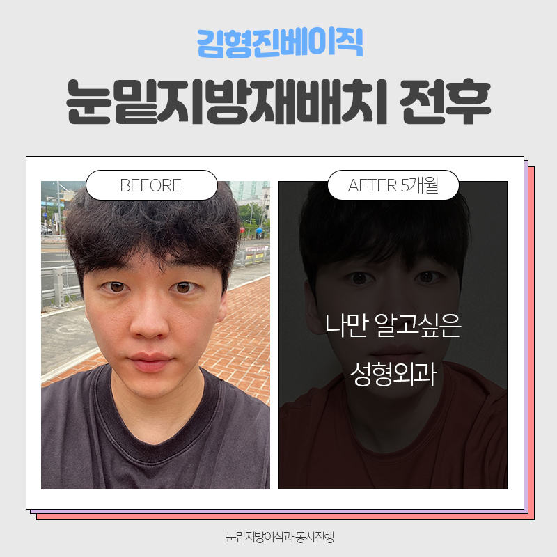 눈밑지방재배치전후 보러오실분 관련 이미지 2