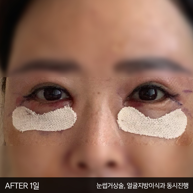 중년눈밑처짐 해결방법은 관련 이미지 3