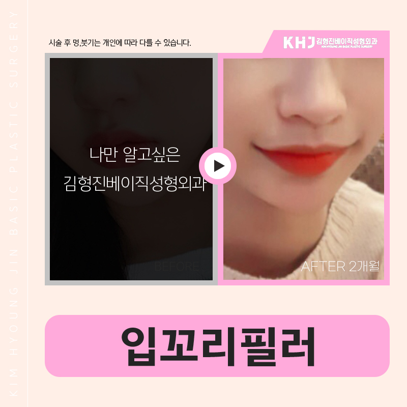 역대급 강남입꼬리필러후기 보고 갈 사람? 관련 이미지 6