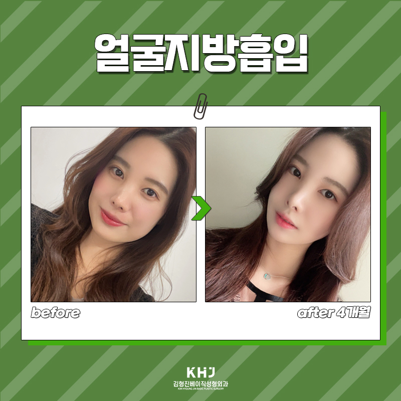 얼굴지방흡입전후 역대급 차이 느끼고 싶다면? 관련 이미지 6