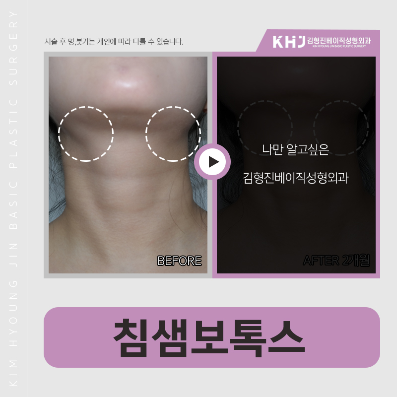 침샘보톡스후기 궁금하신분?? 관련 이미지 5