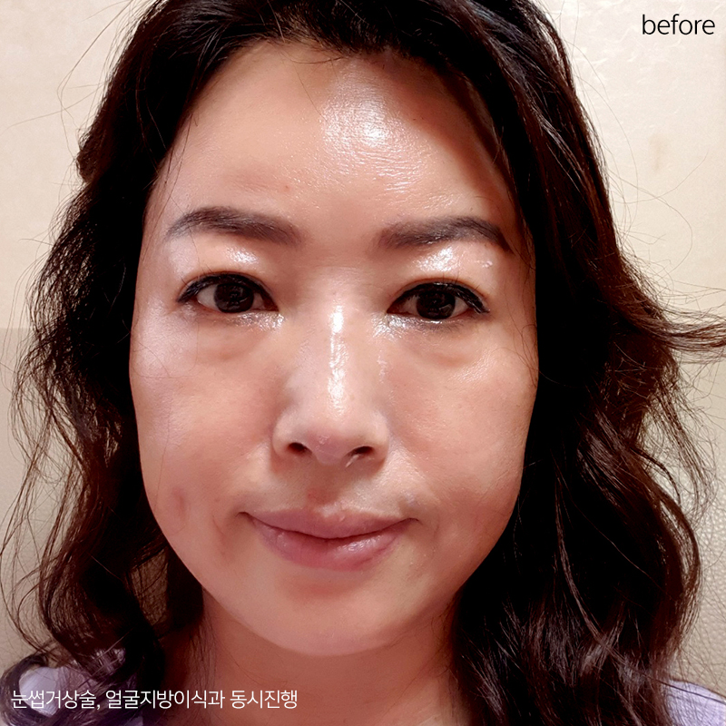 중년눈밑지방 고민은 김형진베이직에서 해결! 관련 이미지 2