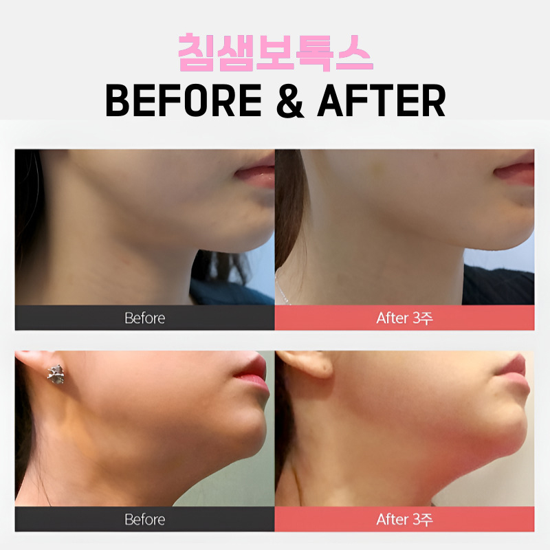 침샘비대증 개선하고 슬림하고 매끈한 라인 완성! 관련 이미지 6