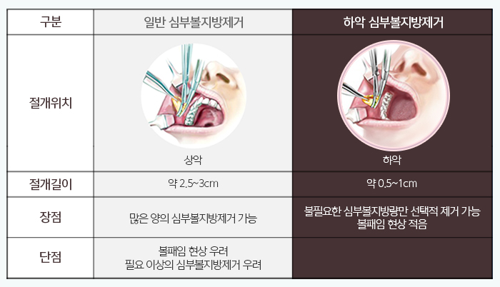심부볼제거전후 김형진뉴라인성형외과에서 관련 이미지 4