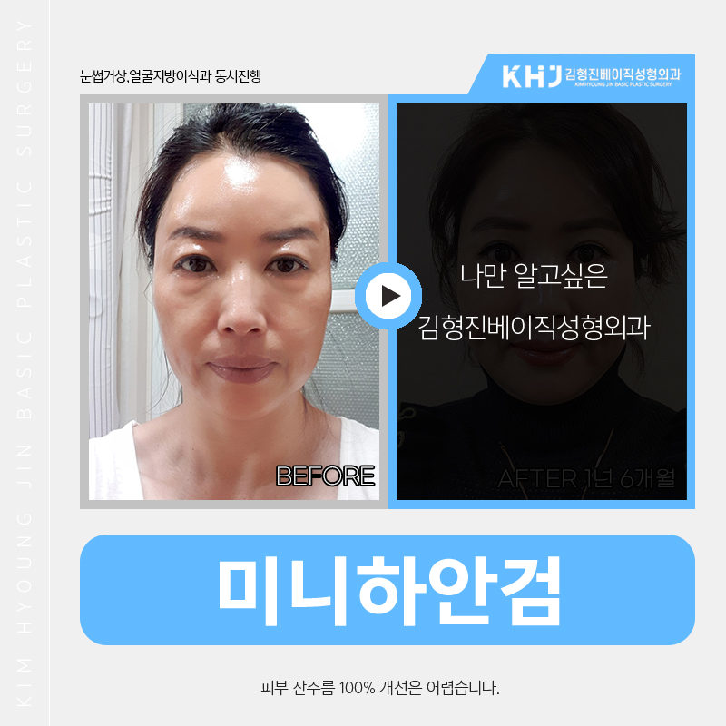 눈밑처짐수술로 나이 들어 보이는 노안 이미지 탈출했어요! 관련 이미지 5