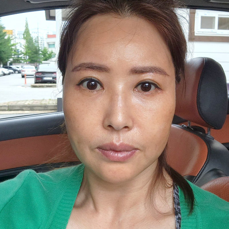 미니하안검붓기 적을 수밖에 없는 이유! 관련 이미지 2