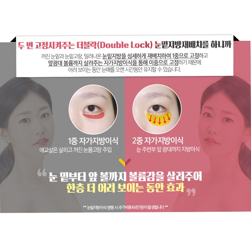 After Gangnam Under-Eye Fat Repositioning, It Looks Like the Under-Eye Fat Was Erased with an Eraserㅠㅠ image 4