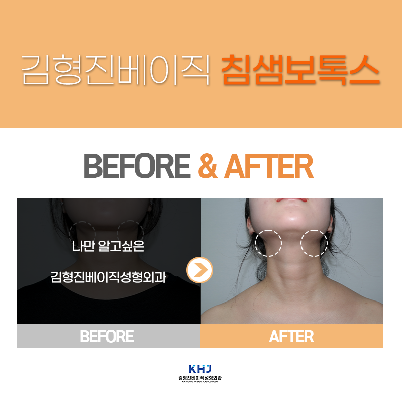 턱밑침샘보톡스효과 확인하고 가세요! 관련 이미지 6