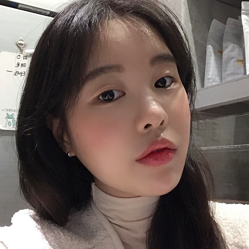 눈밑지방재배치수술 어떻게 진행되냐구요? 관련 이미지 4