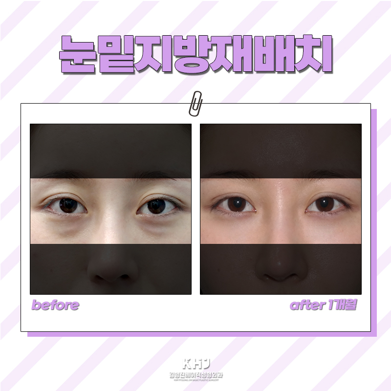 눈밑수술잘하는곳에서 재발없이 오래 유지하는 방법 관련 이미지 6
