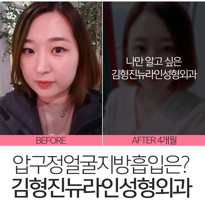 압구정얼굴지방흡입 잘한다고 했죠? 관련 이미지 8