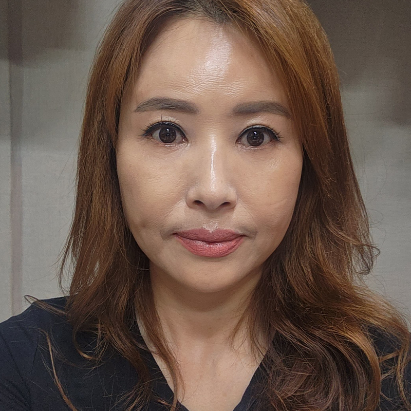 미니하안검흉터 걱정은 이제 그만~! 관련 이미지 1