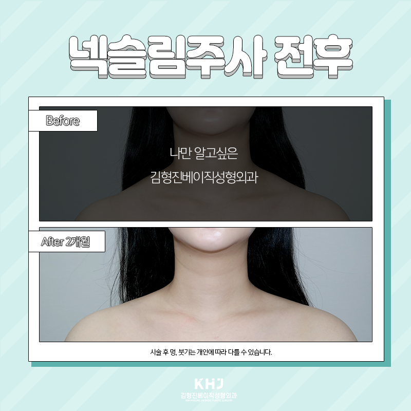 넥슬림주사전후 확인하고 가세요~! 관련 이미지 4