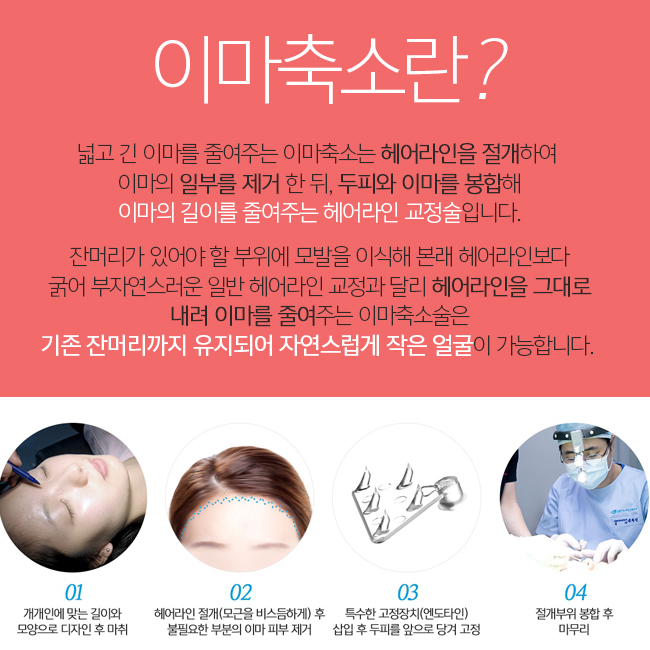 이마축소수술로 넓고 긴 이마를 작은얼굴로! 관련 이미지 2