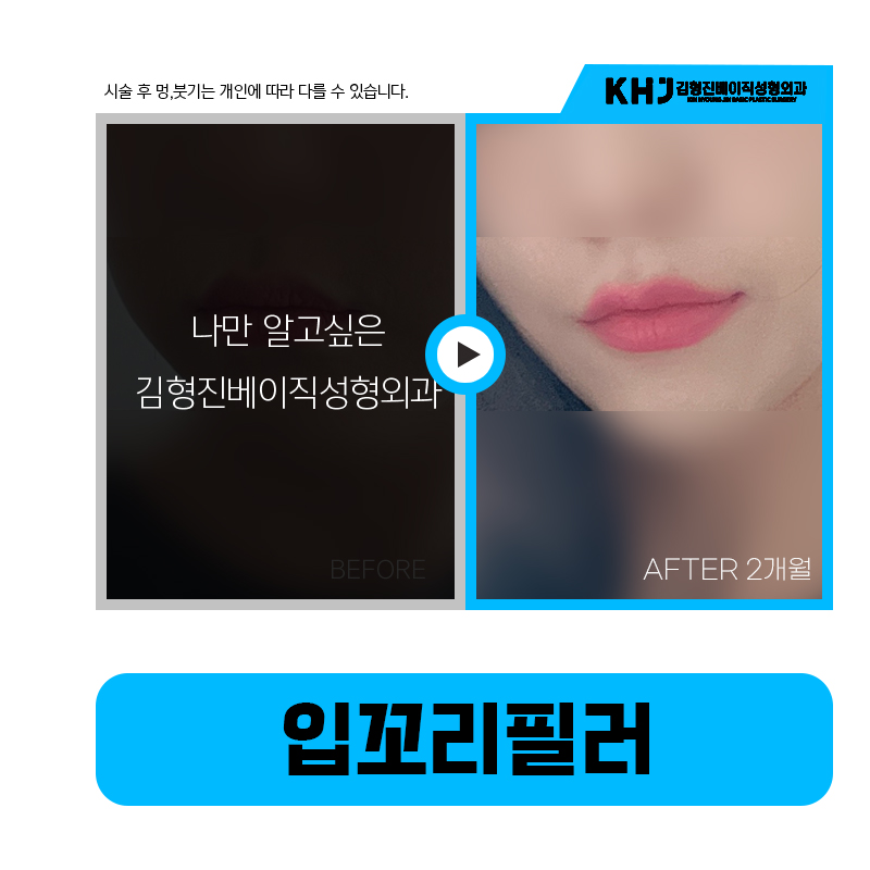 나이 들어 보이는 이유는 처진입꼬리 탓! 쉽게 해결하는 방법은? 관련 이미지 6