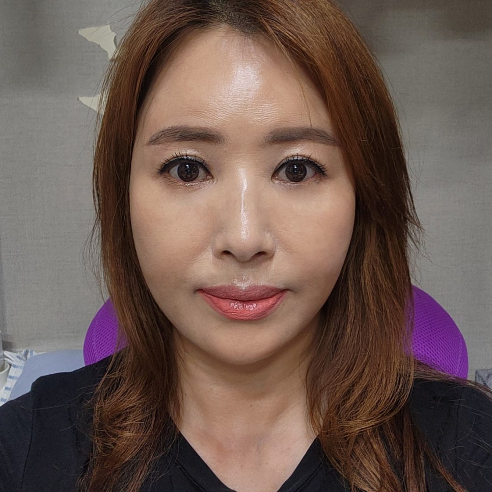 눈밑처짐수술 고민해결하고 동안소리 들어요 관련 이미지 1