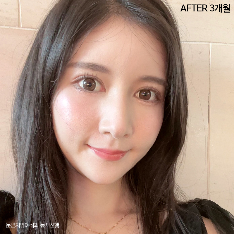 눈밑지방재배치효과 궁금하시죠? 관련 이미지 6