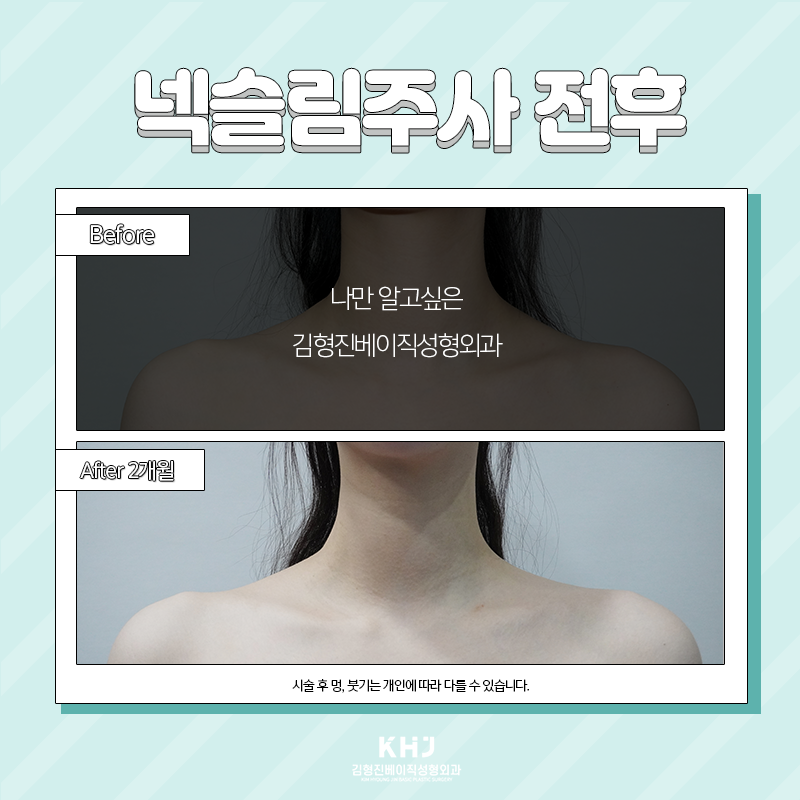 넥슬림주사전후 확인하고 가세요~! 관련 이미지 6