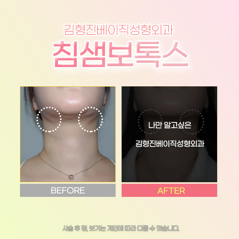 침샘보톡스전후 확인하고 가실래요? 관련 이미지 3