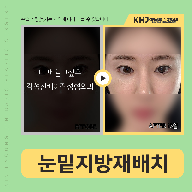 눈밑지방재배치붓기 걱정되신다구요? 관련 이미지 4