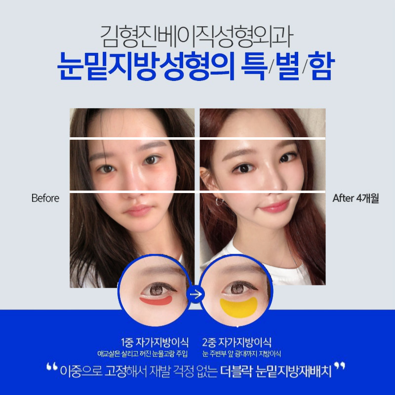 눈밑주름없애는법 찾고 밝은 인상 만들었어요!! 관련 이미지 5