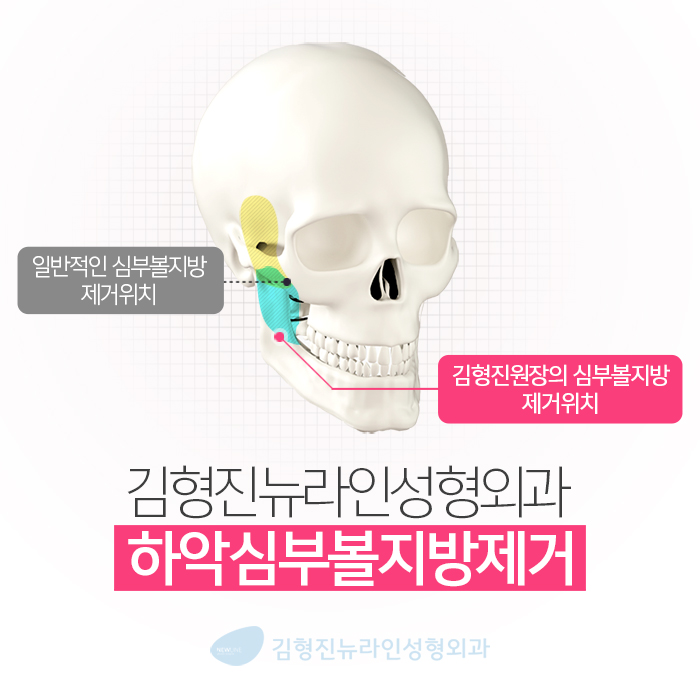 심부볼지방제거성형외과 김형진뉴라인, 알죠? 관련 이미지 4