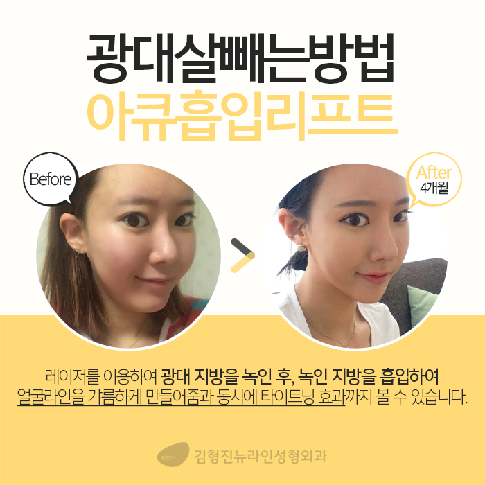 광대지방흡입 김형진뉴라인성형외과지 관련 이미지 4