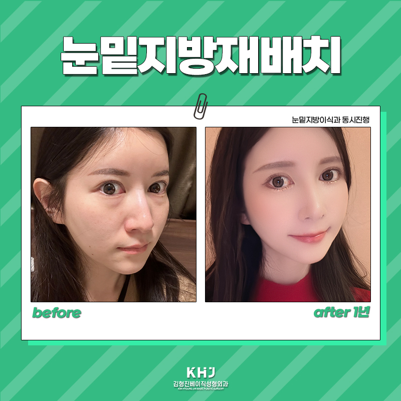 압구정눈밑지방재배치 재발없이 오래도록 유지하는 비결 관련 이미지 6