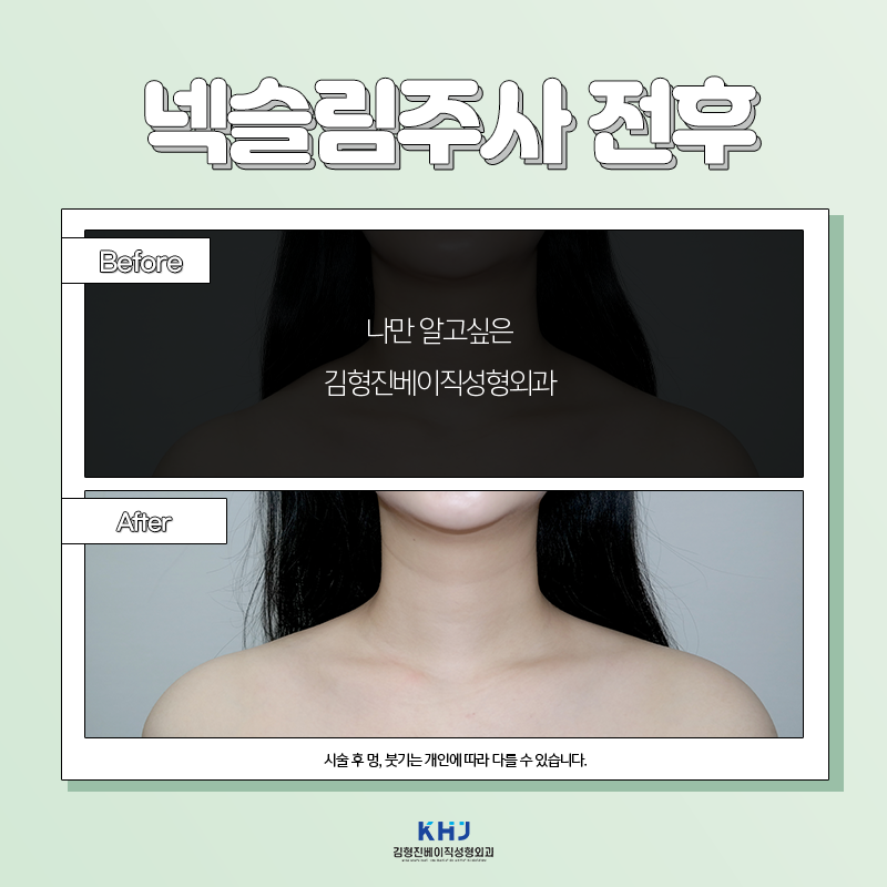 넥슬림주사전후 이렇게나 대단해! 관련 이미지 6