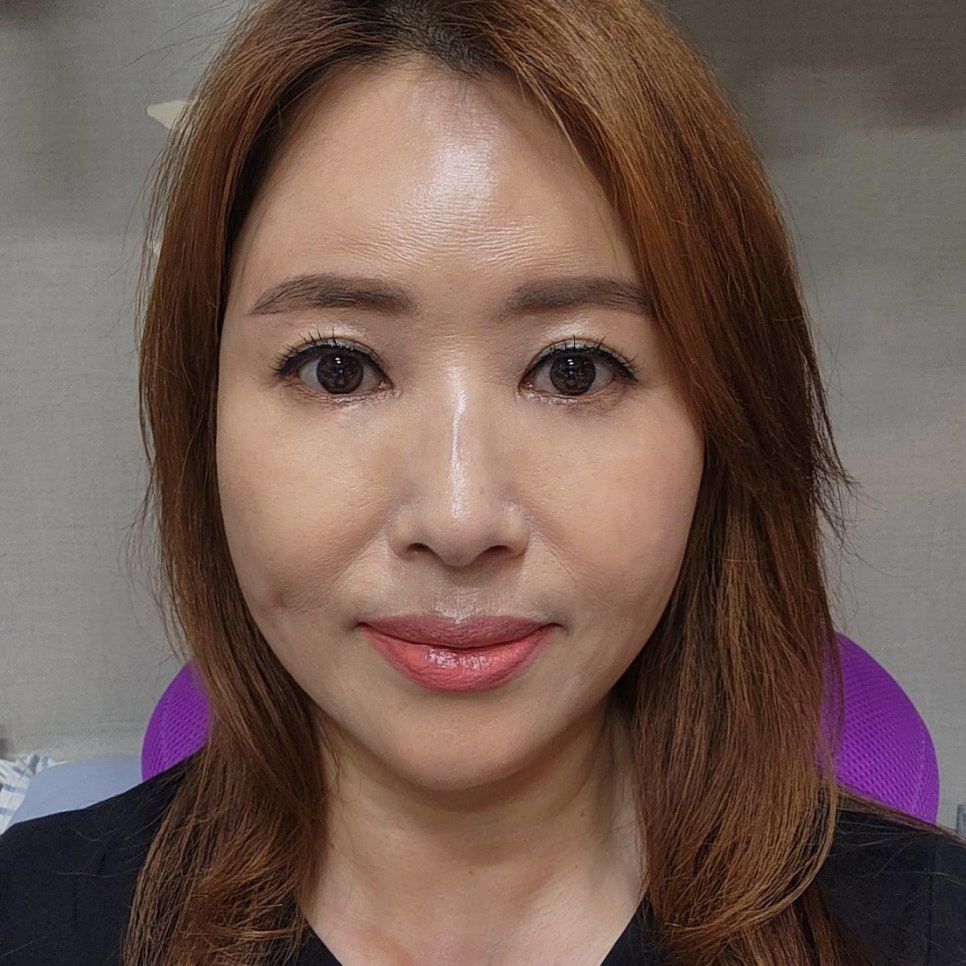 눈밑처짐수술전후 눈밑 흉터 걱정 없었어요 관련 이미지 2