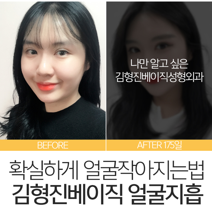 얼굴작아지는법 김형진베이직에서는? 관련 이미지 7