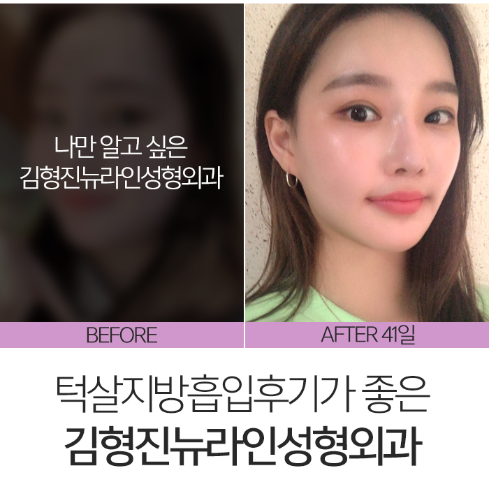 턱살지방흡입후기 확실한 곳 찾아요? 관련 이미지 2