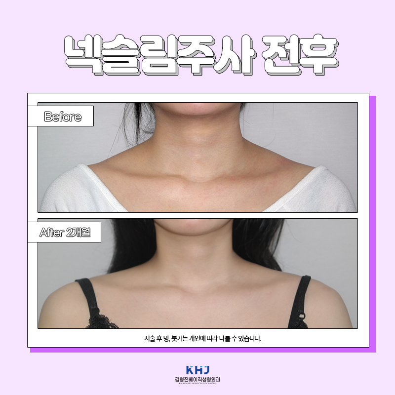 압구정웨딩관리 목 라인과 승모근 라인 한방에 정리하는 방법 관련 이미지 5