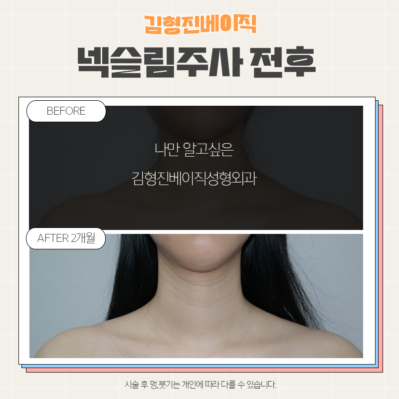 목보톡스후기 김형진베이직만 한 곳 없죠 관련 이미지 5