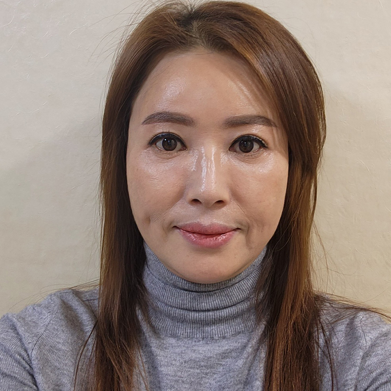 미니하안검수술방법 궁금하시죠? 관련 이미지 1