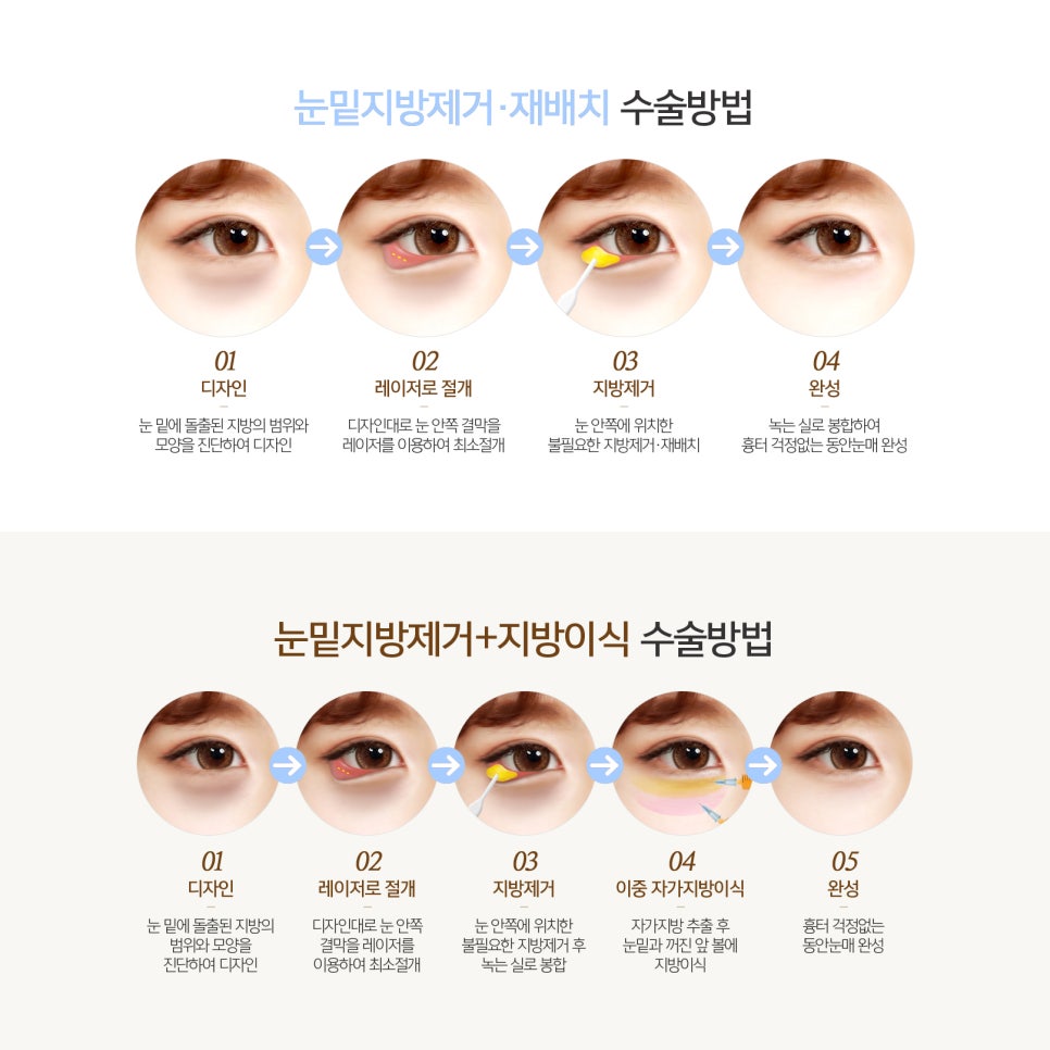 눈밑지방없애는법, 인상까지 부드러워져서 대만족이에요! 관련 이미지 6