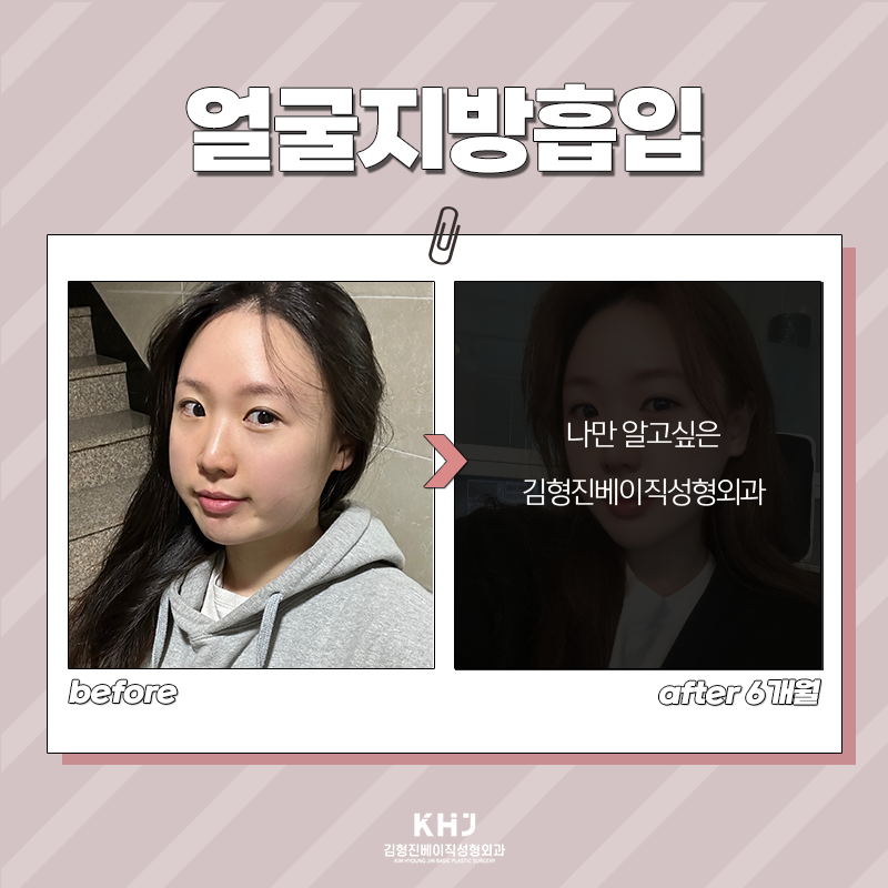 얼굴지방흡입전후 보고 가세요! 관련 이미지 4