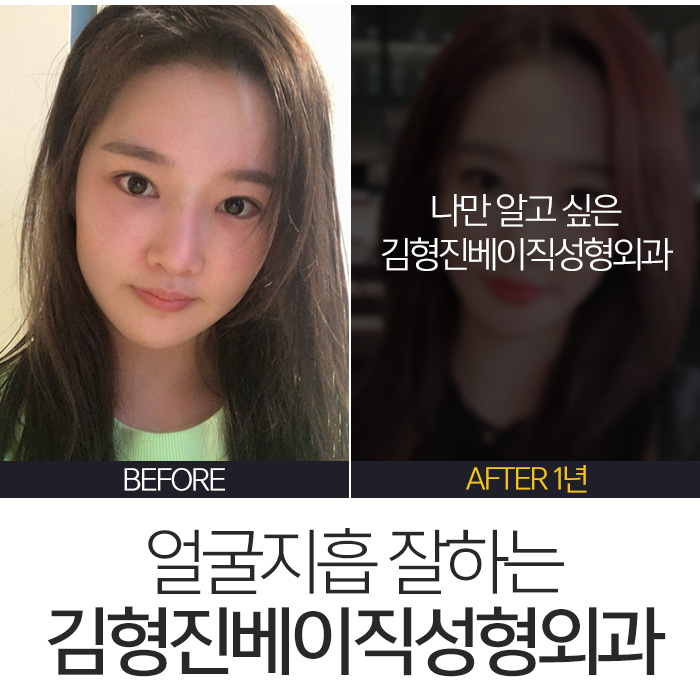 김형진베이직얼굴지흡 얼마나 잘하냐면요 관련 이미지 6