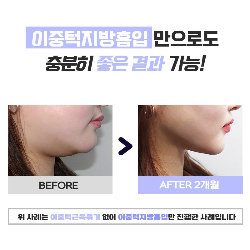 압구정이중턱제거로 사라진 턱선 되찾았어요 관련 이미지 5