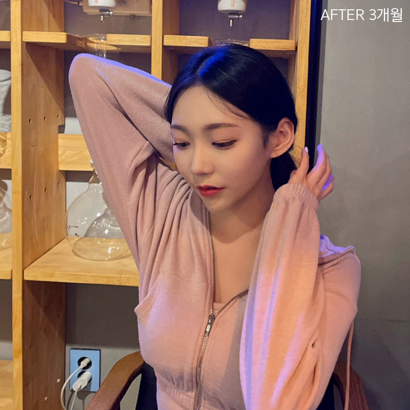 심부볼제거잘하는곳은? 바로 김형진베이직이죠! 관련 이미지 6