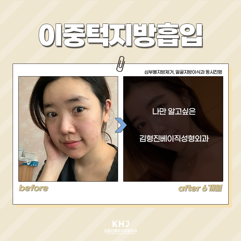 이중턱지방흡입전후 보고 가세요! 관련 이미지 4