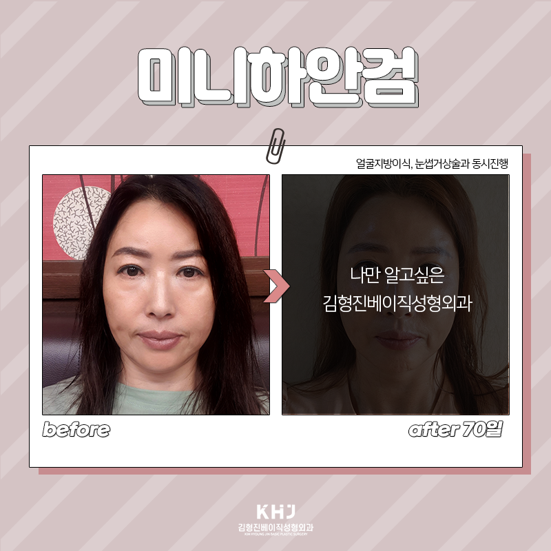 중년눈밑처짐 걱정하지 마세요! 관련 이미지 5